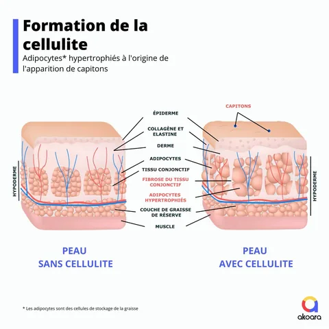 Schéma représentant une peau avec et sans cellulite