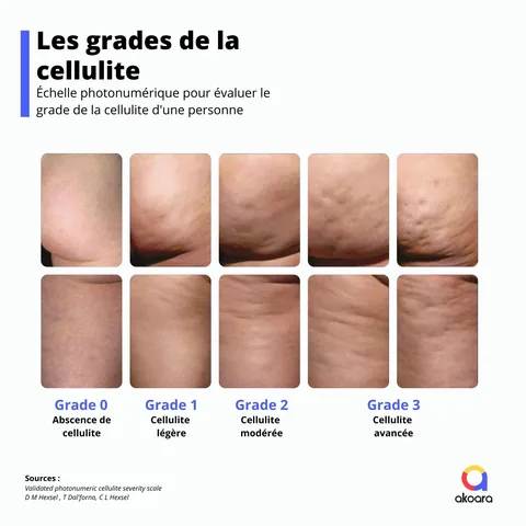 Photos des différents grades de sévérité de la cellulite fesses et jambes