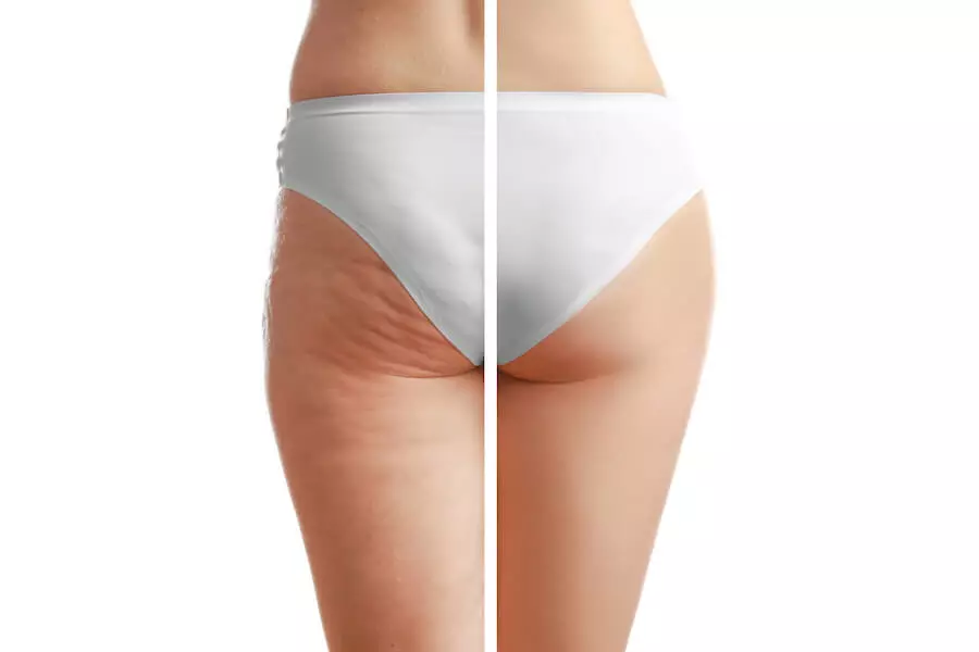 Cellulite avant après traitement et sport sur un modèle féminin