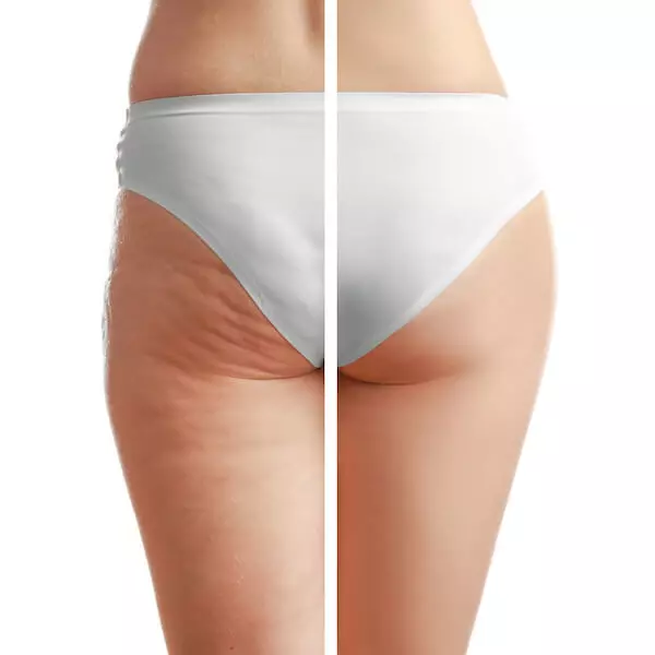 Cellulite avant après fesses