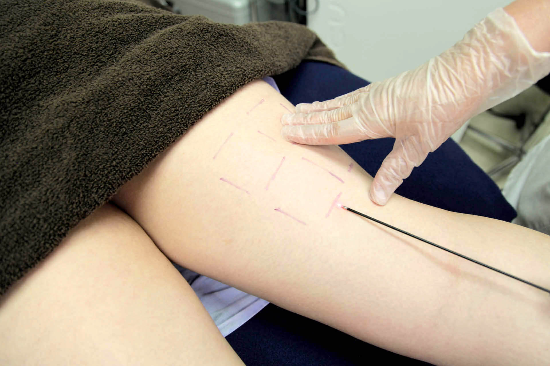 Laser Cellulaze sur la jambe d'une jeune femme