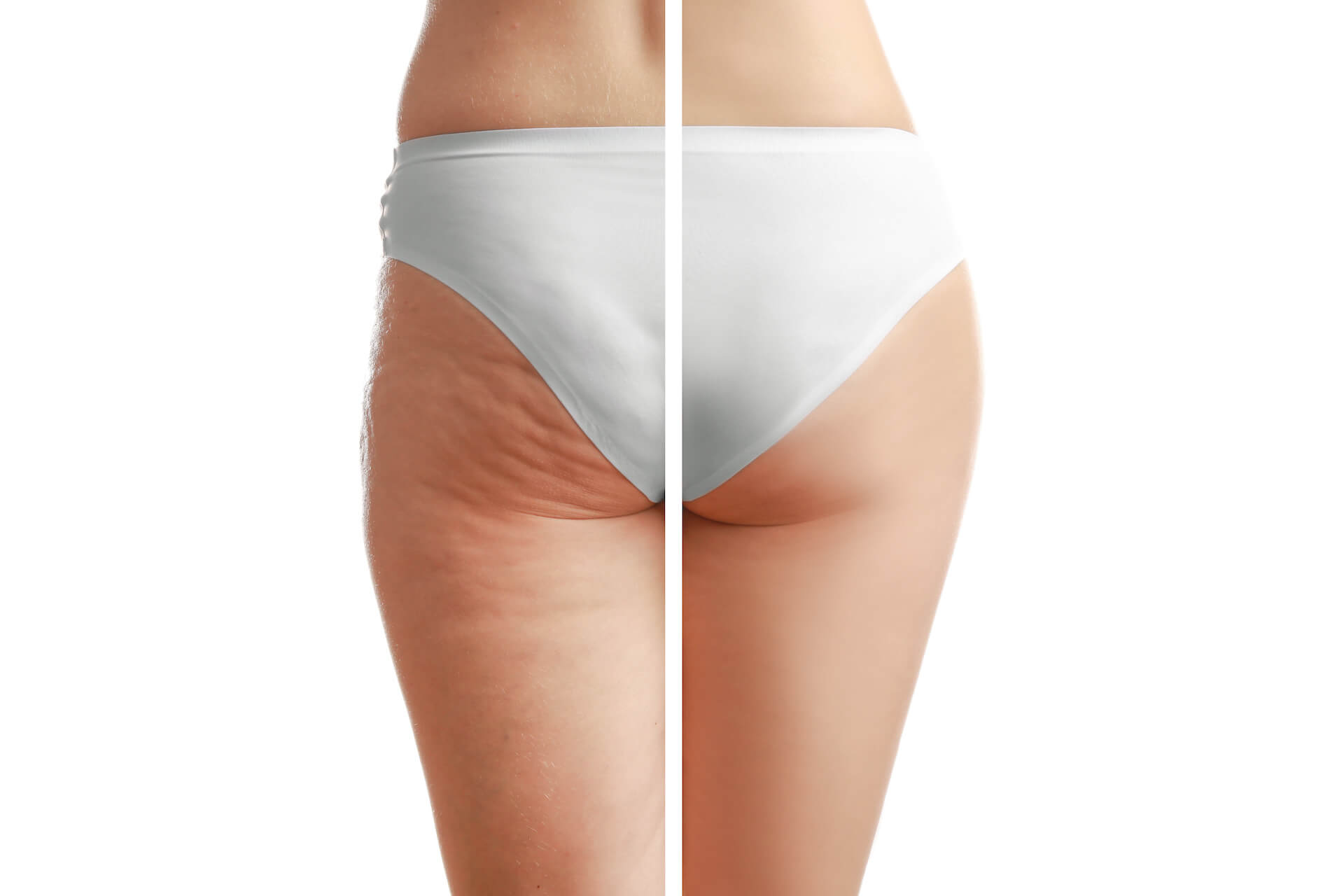 Cellulite avant après traitement jambes et fesses comparaison